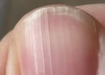 thumbnail showing vertical ridges from thyroid disease